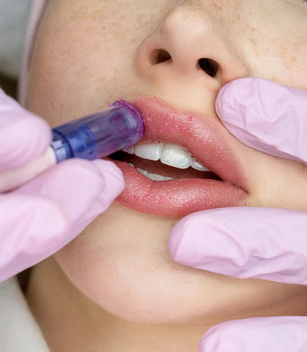 Procedimento clínico de Hidra Gloss com microinfusão labial de ativos