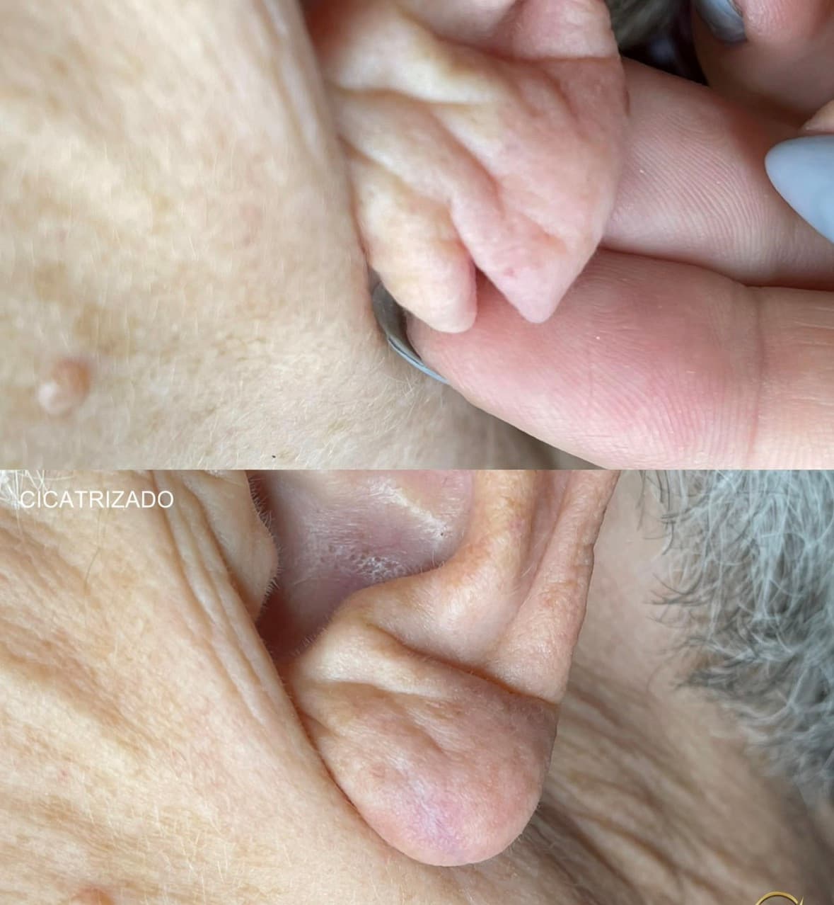 Antes e depois de procedimento de Lobuloplastia na orelha cicatrizada
